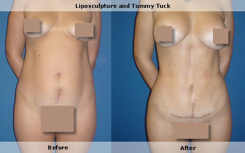 tummy tuck with anchor incision